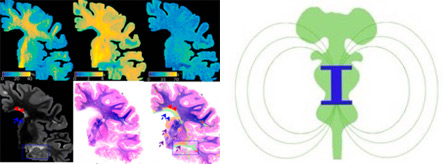 Imaging hidden mechanisms of disease in multiple sclerosis image